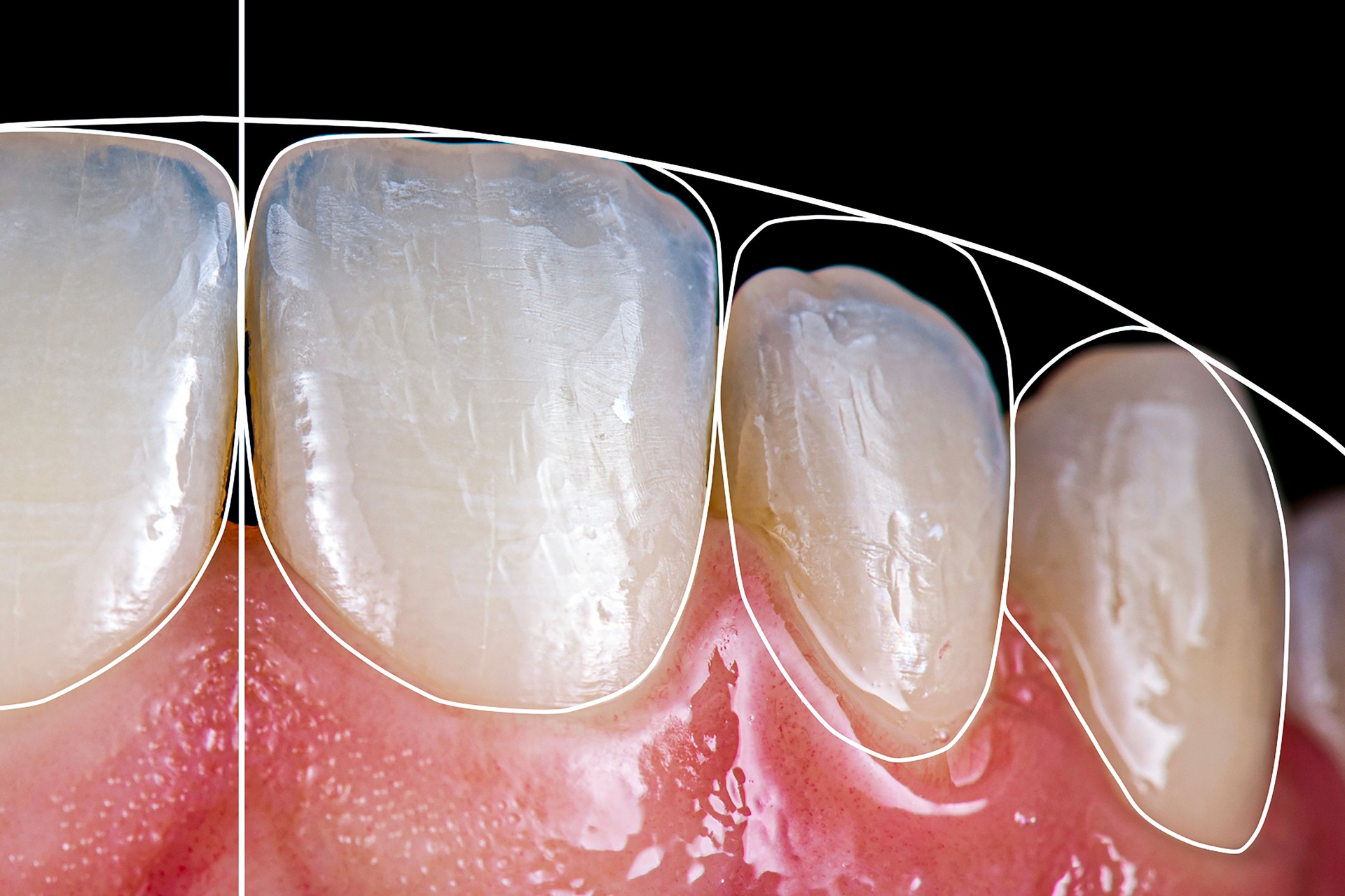 ceramic crowns and venners